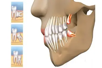 Yirmilik Diş Ağız Kokusu Belirtileri ve Tedavisi
